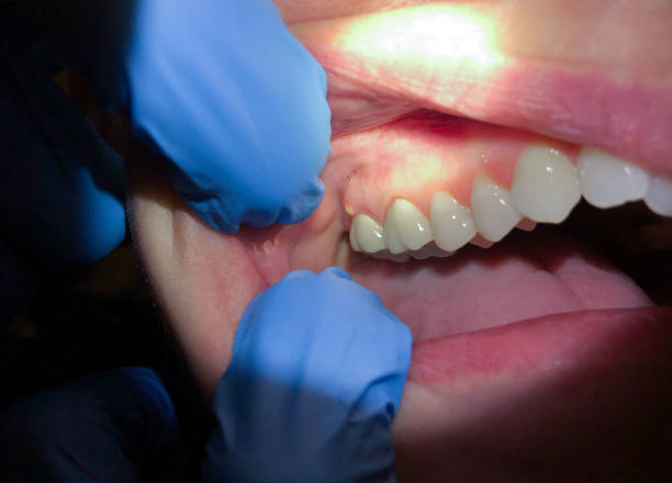 Best Knocked-Out Tooth (Avulsed Tooth) Treatment in Parsons, KS